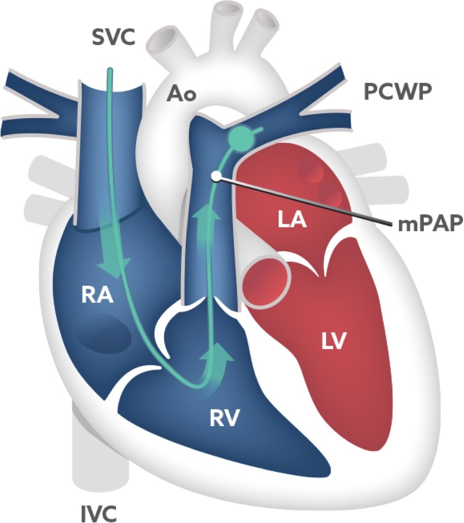 Diagram of what patients can expect from their right heart catheterization.