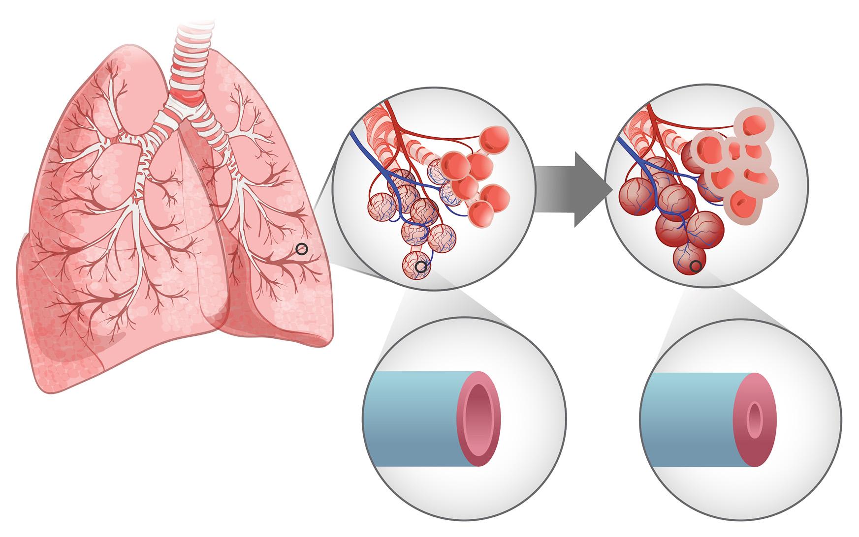 The pathophysiology of interstitial lung disease (ILD) involves changes to the lungs such as abnormal microvasculature, hypoxia-induced vasoconstriction, and pulmonary vascular remodeling. These alterations increase pulmonary vascular resistance and can contribute to the development of pulmonary hypertension.